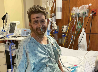 Ingrowing hair puts man in coma with 4% survival chance
